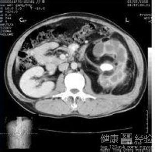 肾囊肿最新治疗方法